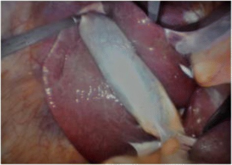Laparoscopic view of the gallbladder (cholecystectomy)
