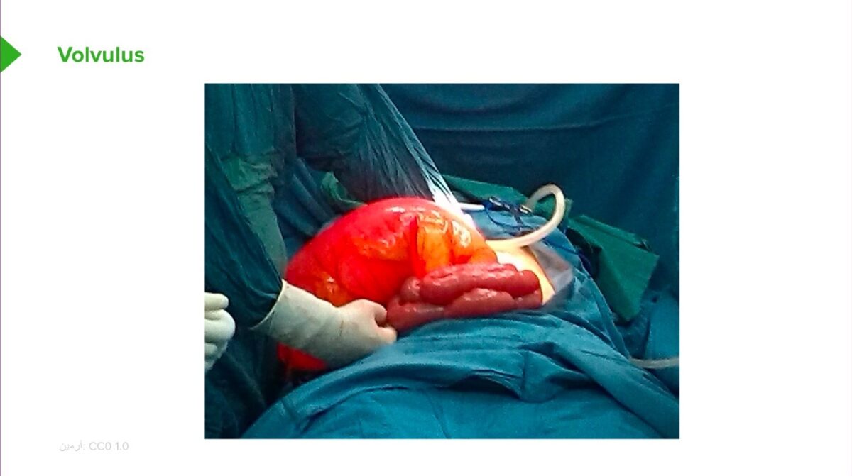 Large intestines colon volvulus Large intestines colon volvulus