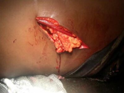 Large left thoraco-abdominal wound with epiplocele