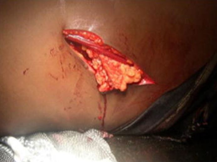 Grande ferida tóraco-abdominal esquerda com epiplocele