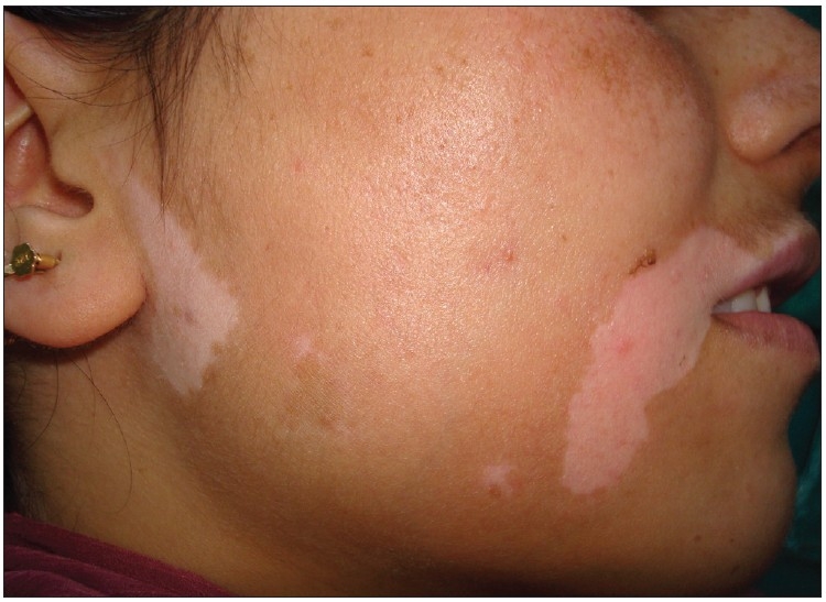 Large patches of hypopigmentation in vitiligo