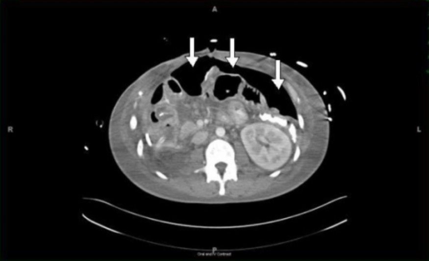 Perforated Viscus Concise Medical Knowledge