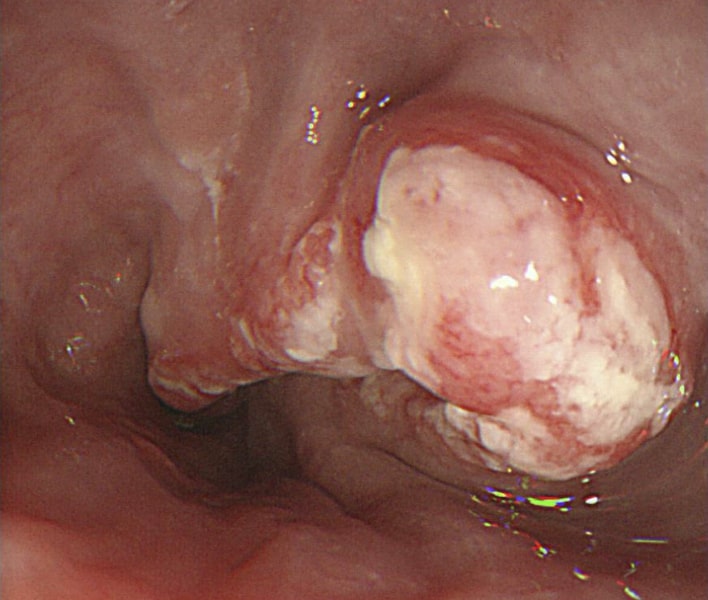 Late-stage squamous cell carcinoma of the esophagus