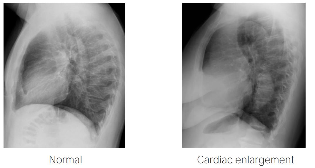 Lateral x-ray projections showing a normal heart (left) and an enlarged heart (right)