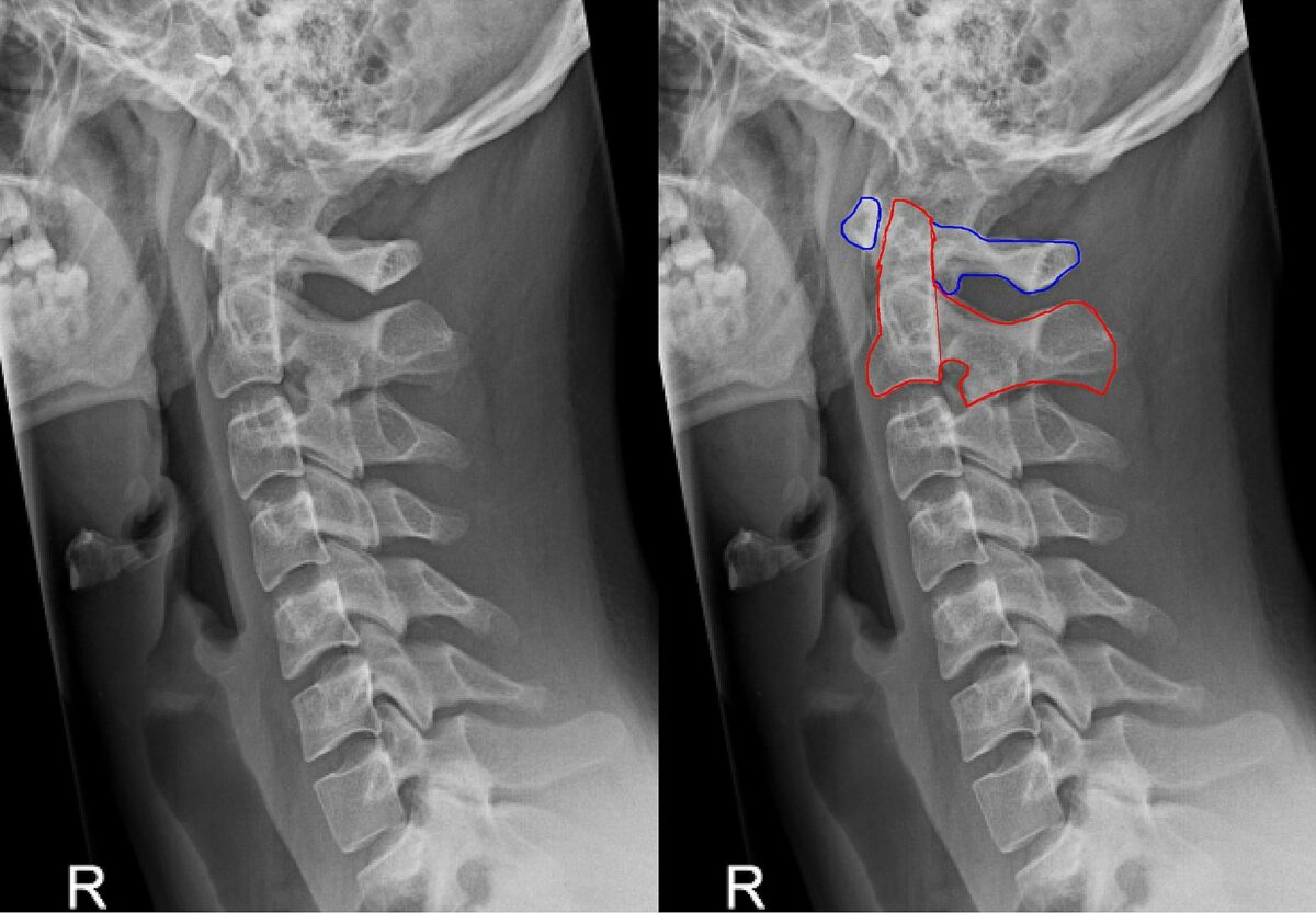 Lateral cervical spine x-ray