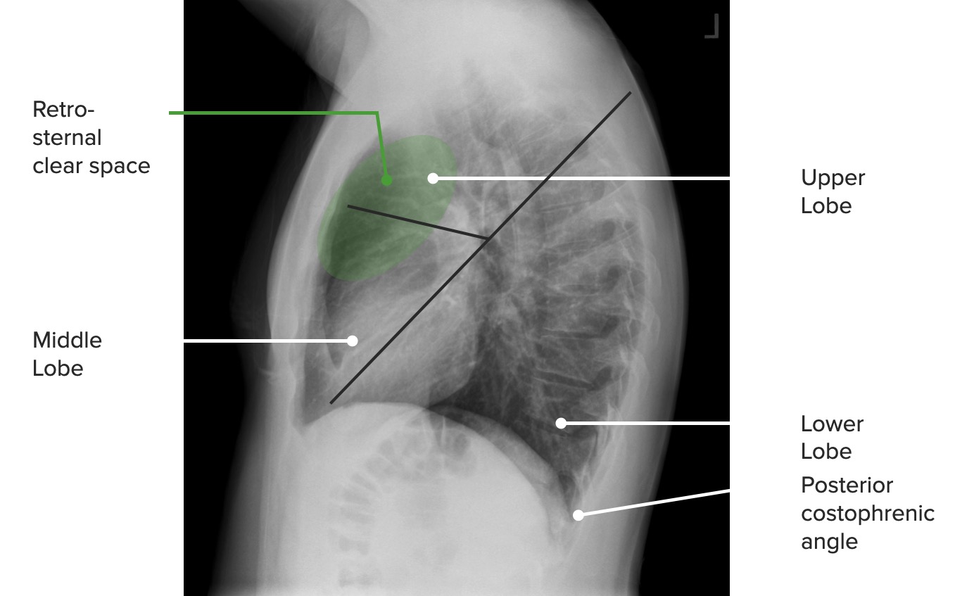 Lateral projection of the chest