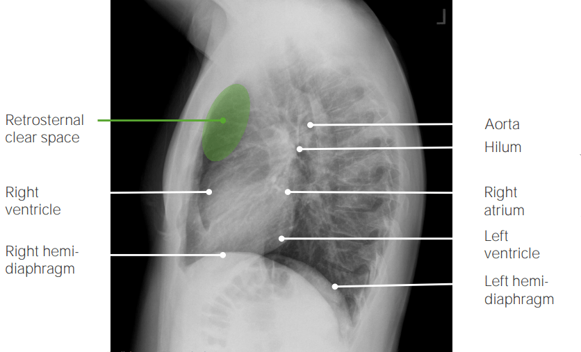 Visão lateral na radiografia de tórax mostrando achados normais
