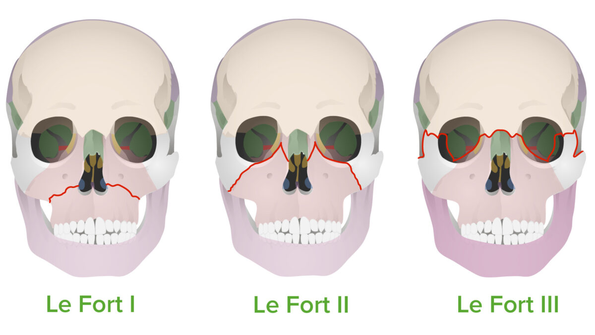 Le fort fracture types