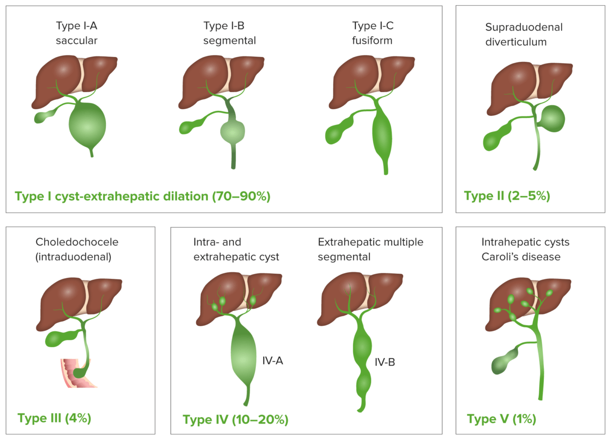 Classification of choledochal cyst