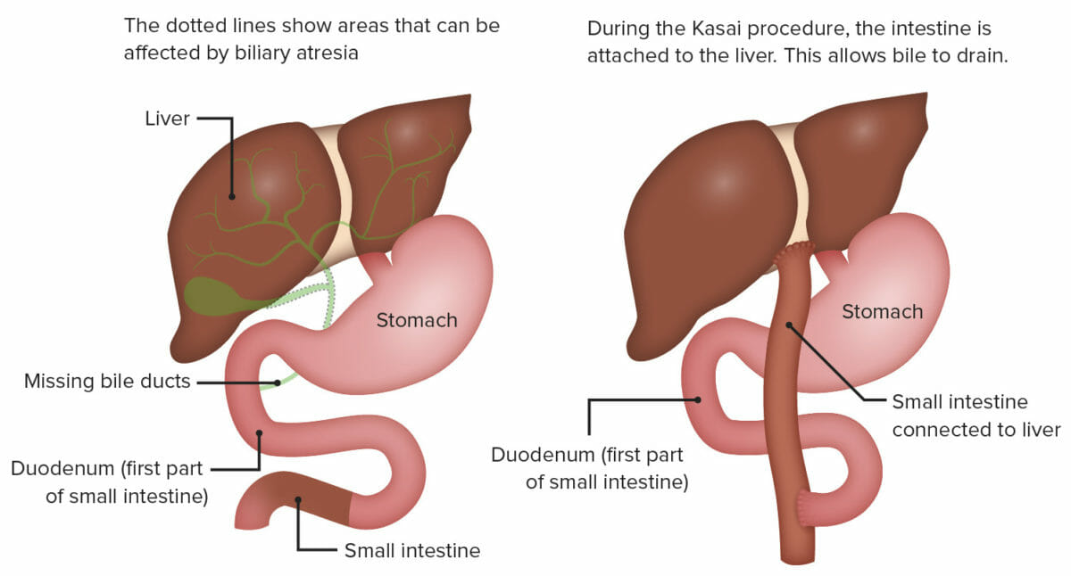 Kasai procedure diagram