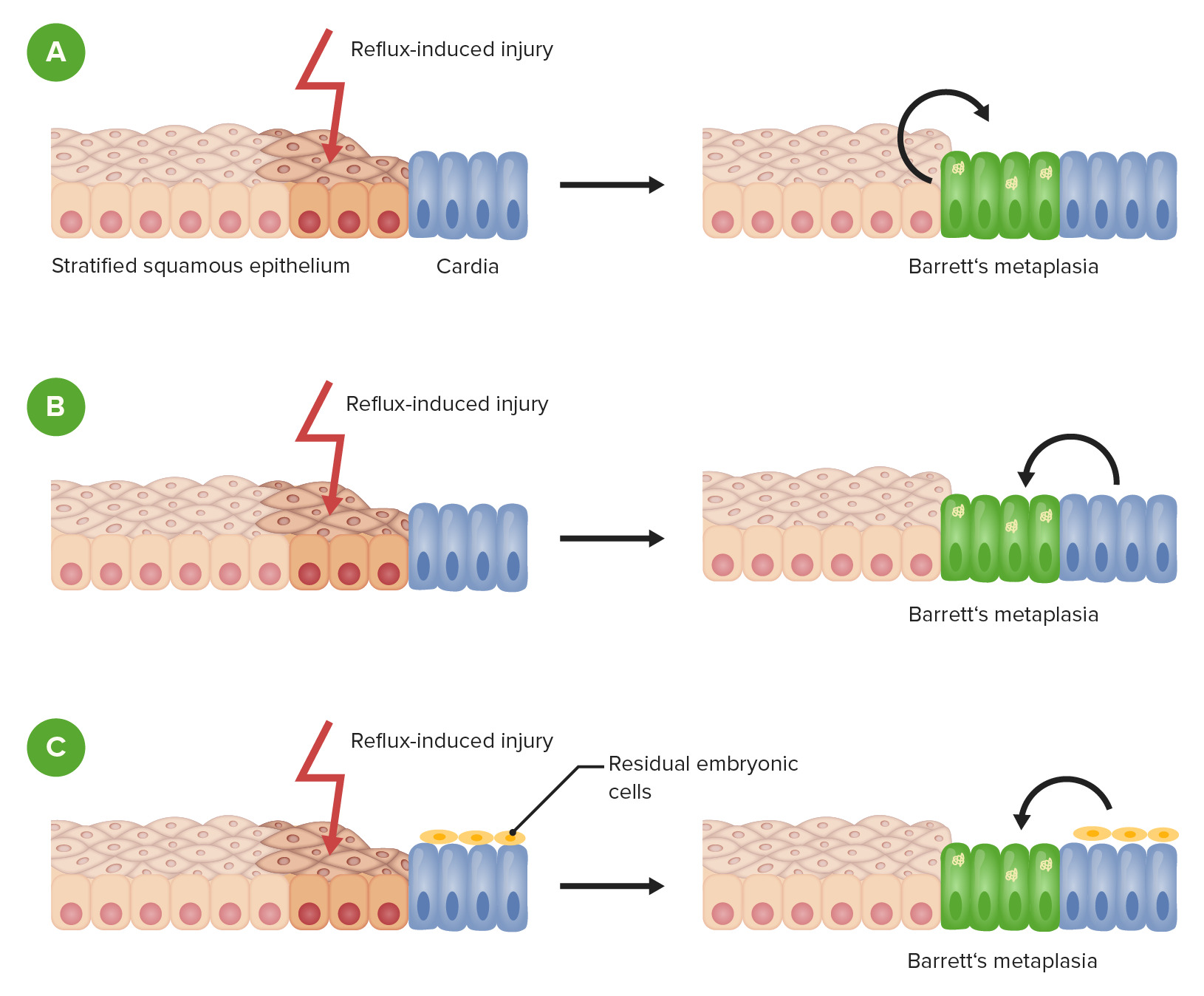 barretts esophagus histology