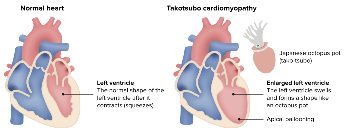 Miocardiopatía de takotsubo