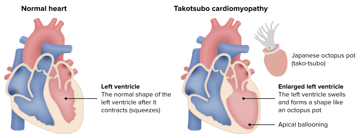 Takotsubo Cardiomyopathy | Concise Medical Knowledge