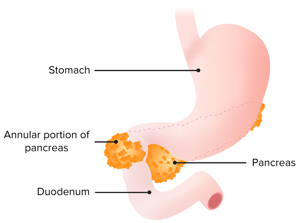 Annular pancreas with a band of pancreatic tissue surrounding the duodenum leading to obstruction