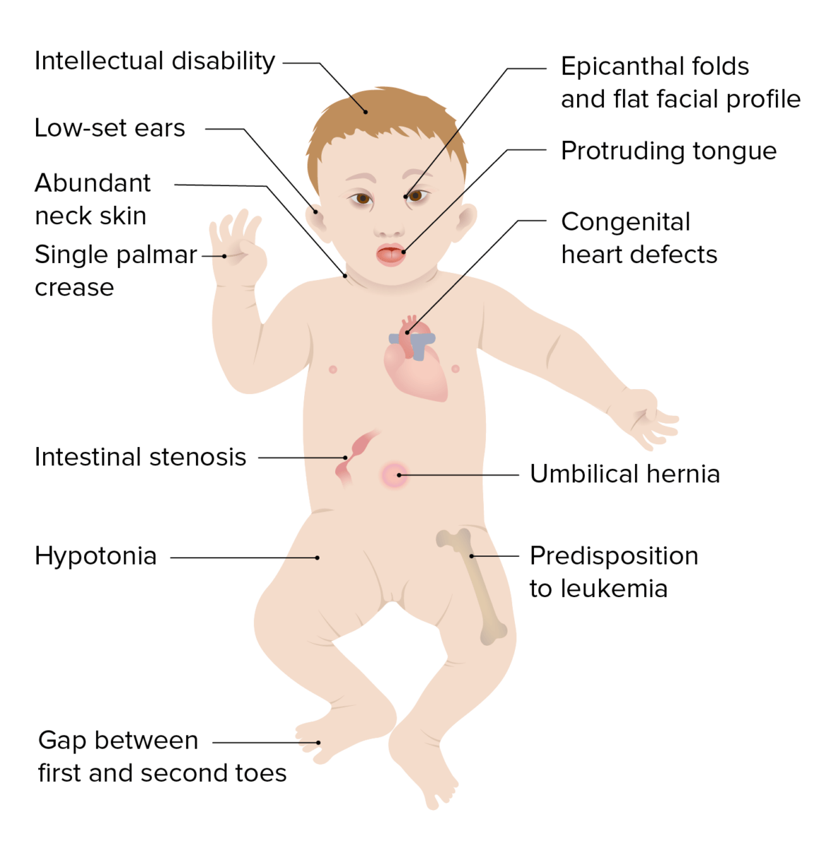 Clinical presentation of down syndrome