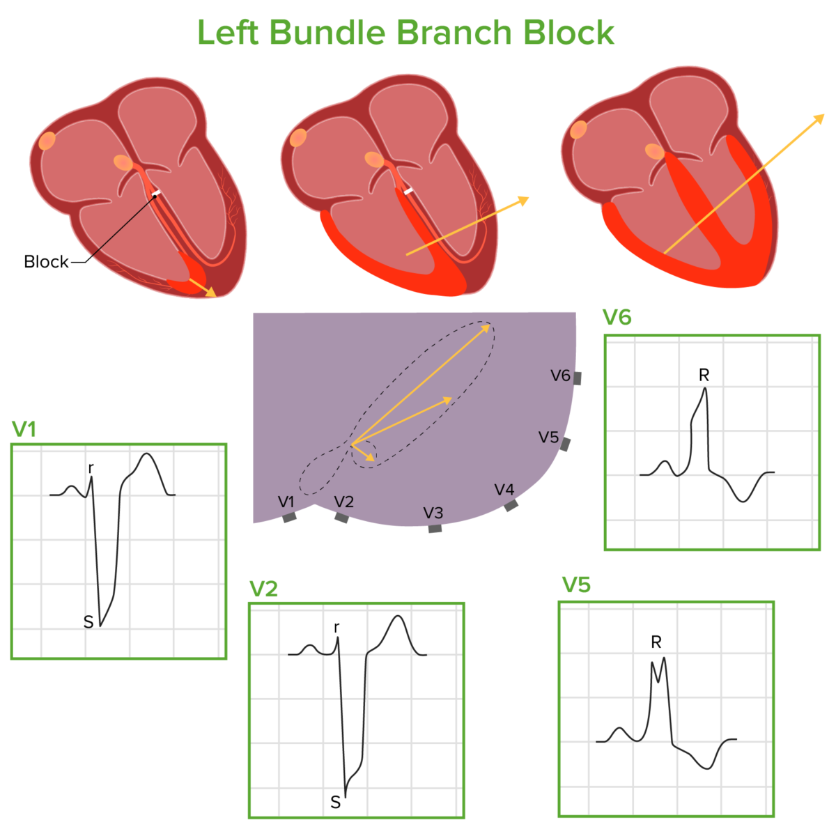 Left bundle branch block pathophysiology