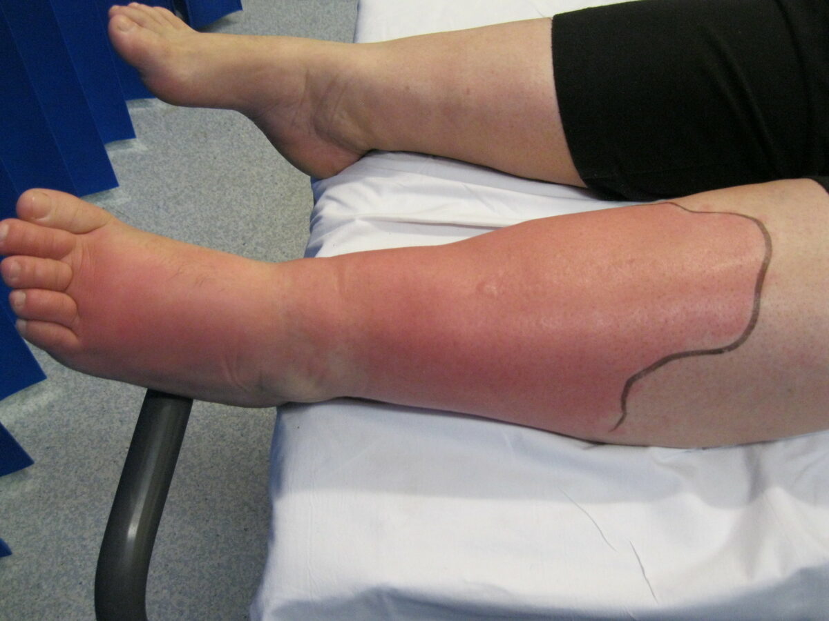 Left lower extremity cellulitis