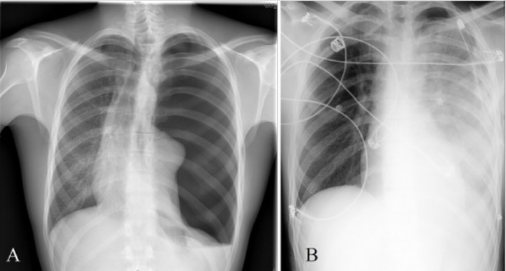 Left tension pneumothorax x-ray