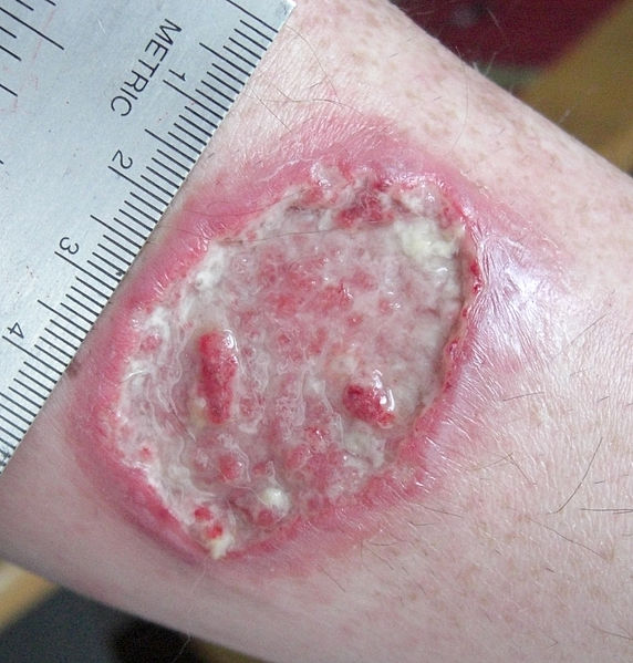 Leishmaniasis skin ulcer
