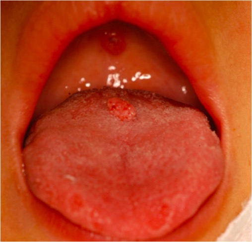 Lesion in mouth of sexually abused child