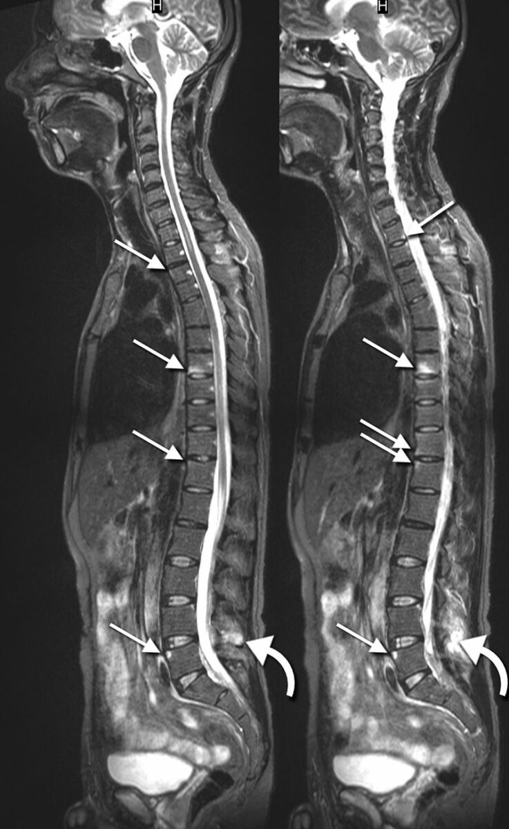 Ankylosing Spondylitis Mri Lumbar Spine