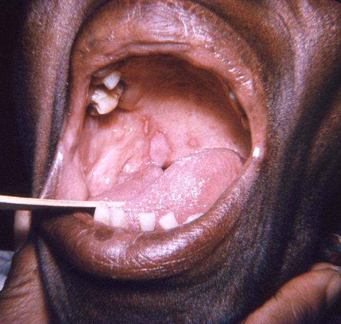 Lesions on the soft palate and tongue herpes simplex virus