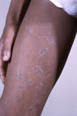 Skin Rash Localized Generalized and Localized Rashes | Concise Medical Knowledge