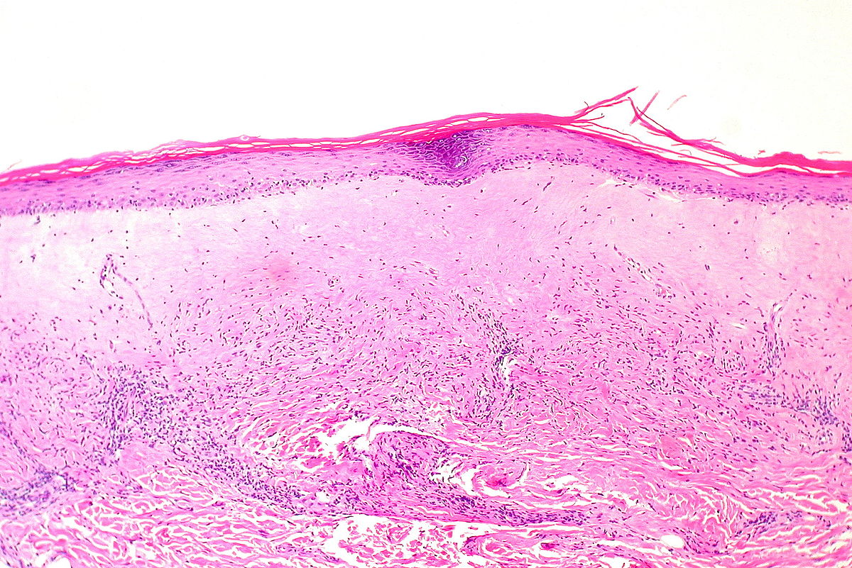 Corte histológico de uma biópsia vulvar demonstrando os achados característicos do líquen escleroso