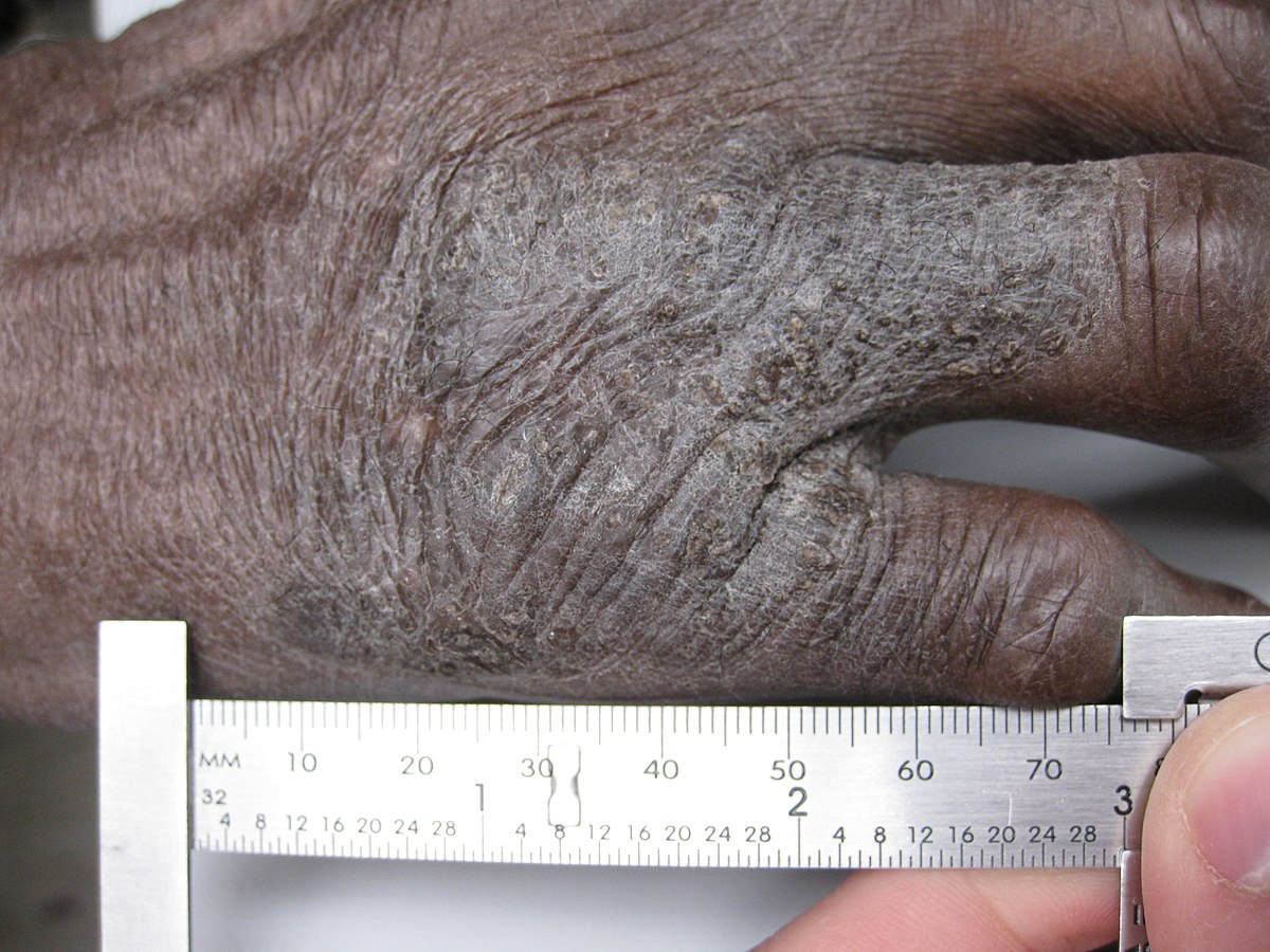 Lichen simplex chronicus of the hand