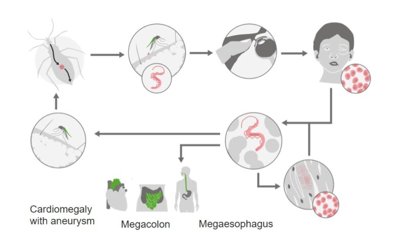 Trypanosoma Cruzi/Chagas Disease | Concise Medical Knowledge