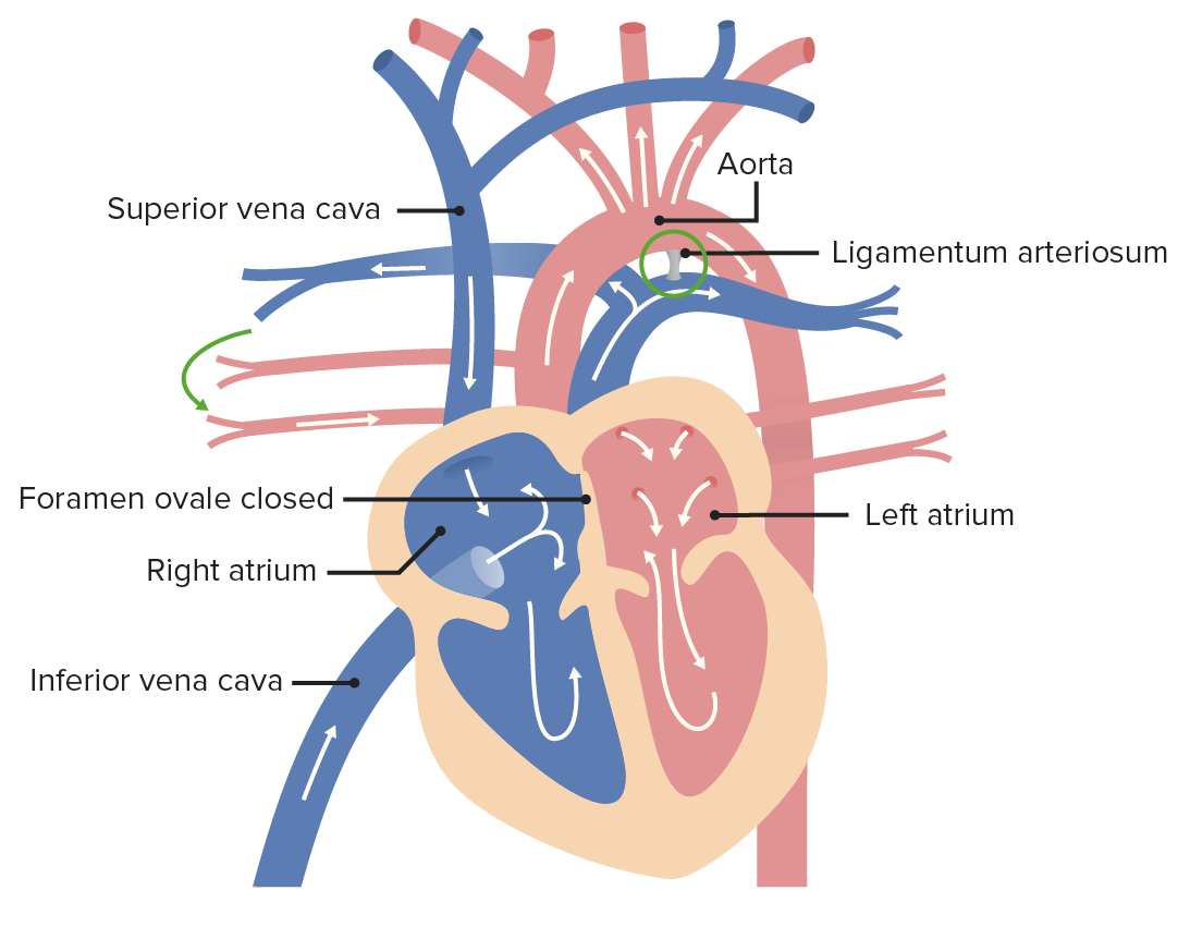 Ligamentum arteriosum