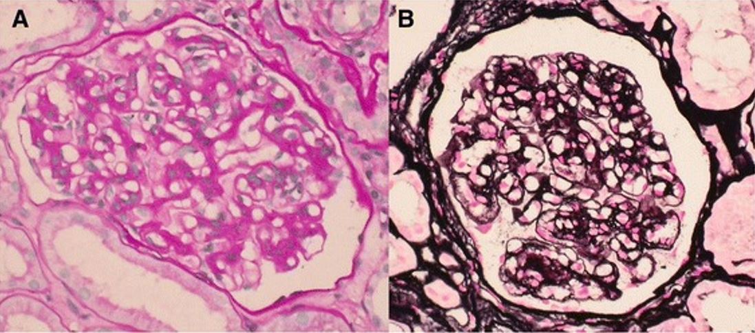Light microscopic features of membranoproliferative glomerulonephritis