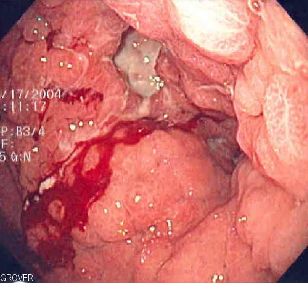 Gastric cancer emedicine, Adenomul hepatic