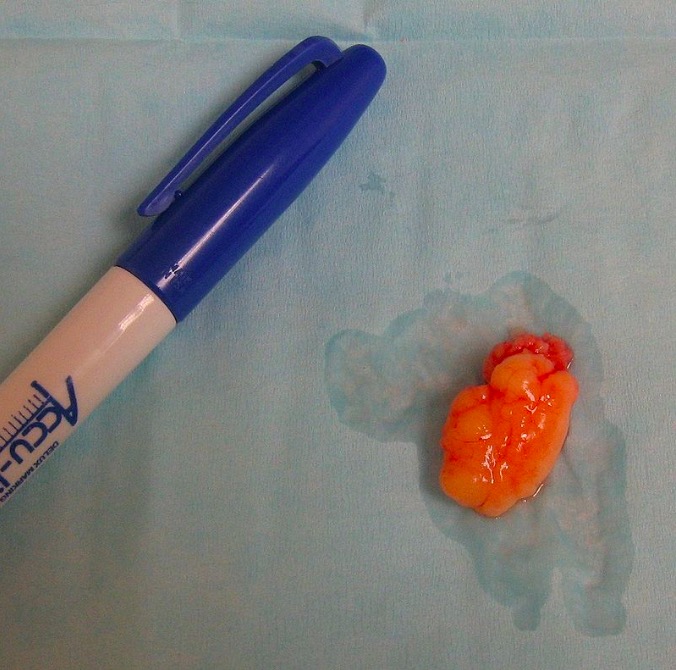 Lipoma removed from the flank of a human being