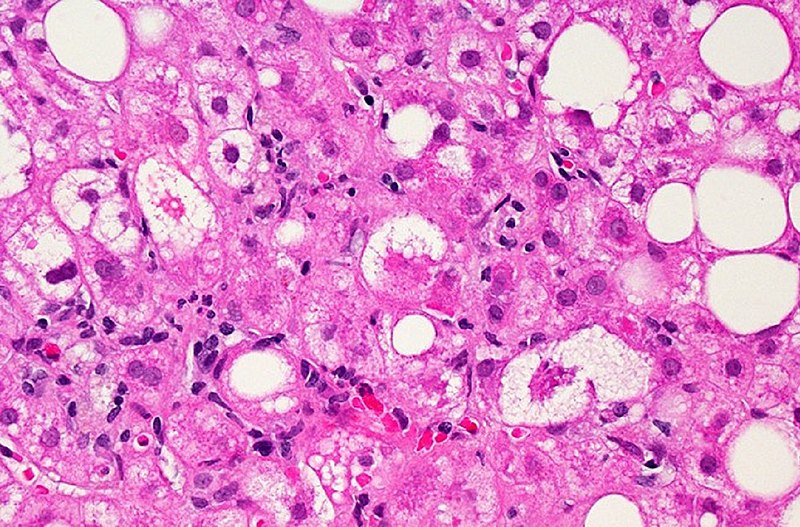 Liver tissue with nafld