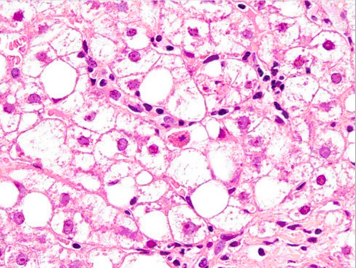Liver biopsy showing signs of toxic-metabolic disorder