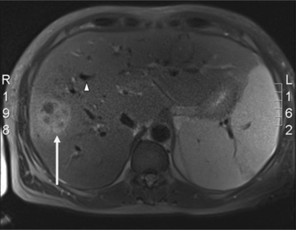 Entamoeba Histolytica Liver Abscess