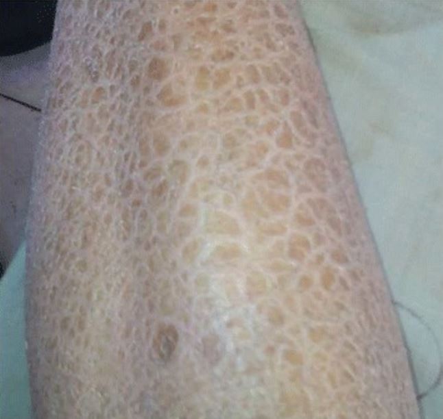 Lizard skin appearance of ichthyosis
