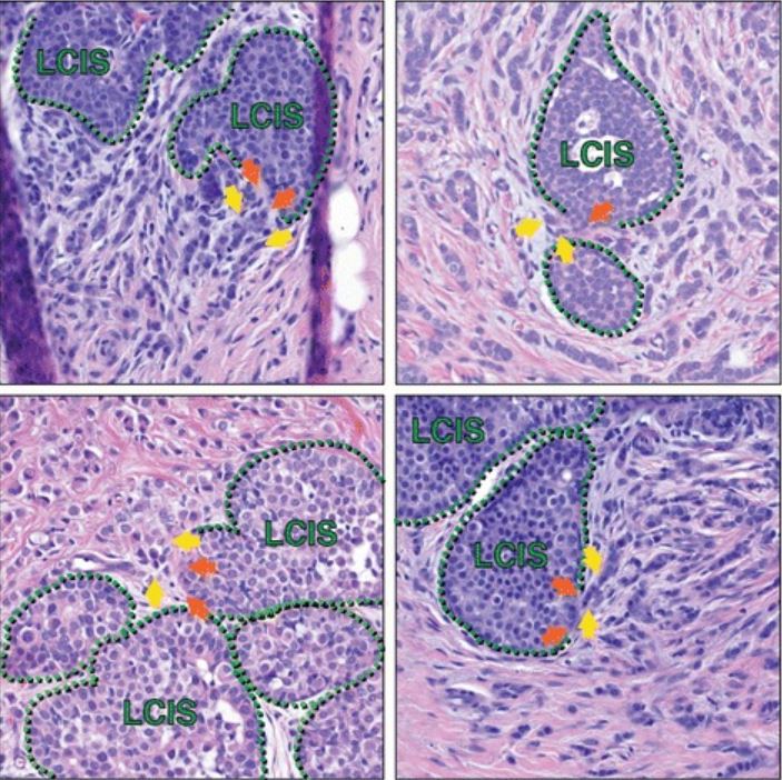 Lobular carcinoma in situ in association with invasive lobular carcinoma