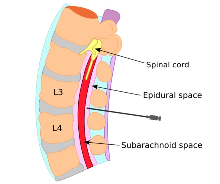 Localização da epidural