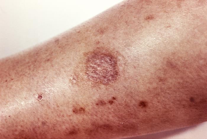 Localized tissue necrosis on the skin due to a brown recluse spider bite
