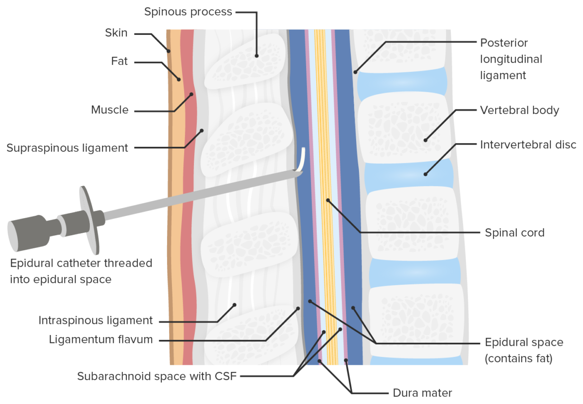 Location of epidural catheter placement