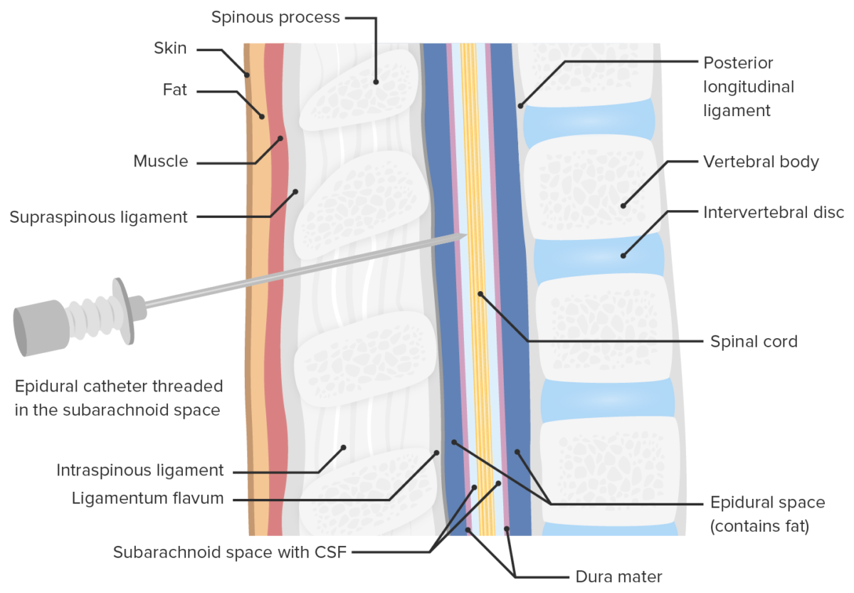 Location of opioid injection during spinal anesthesia