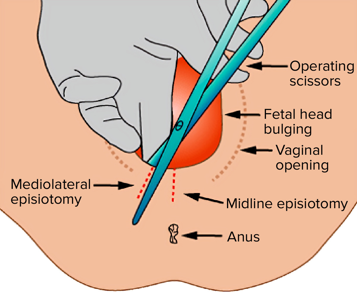Locations of a midline vs. Mediolateral episiotomy