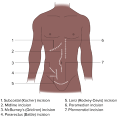 Location of surgical incisions