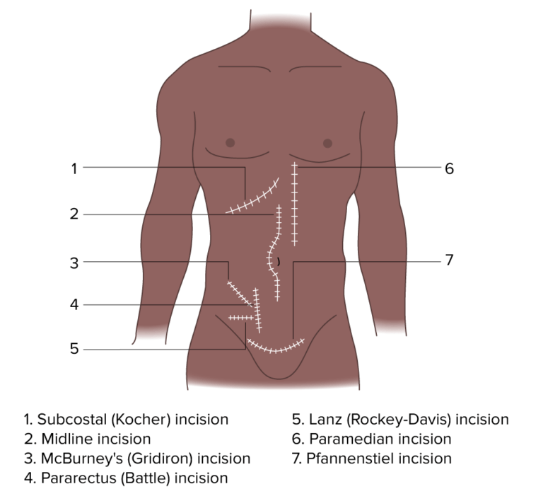 Laparotomy and Laparoscopy | Concise Medical Knowledge