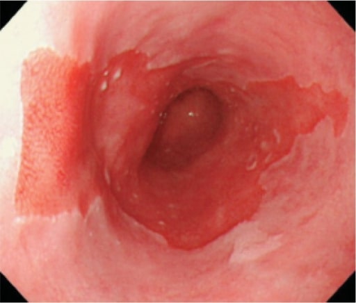 Long segment barrett’s esophagus