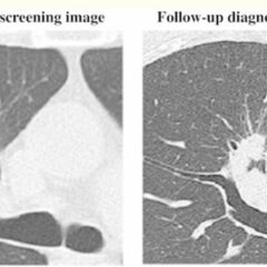 Low-dose CT for lung cancer screening adenocarcinoma