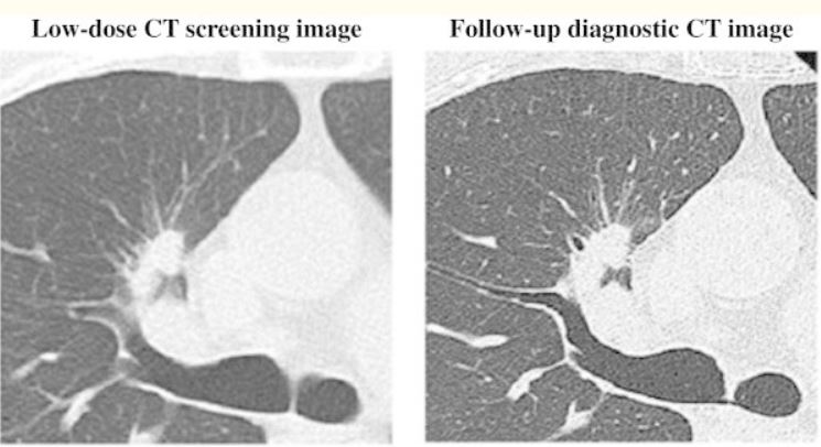 Low-dose ct for lung cancer screening adenocarcinoma