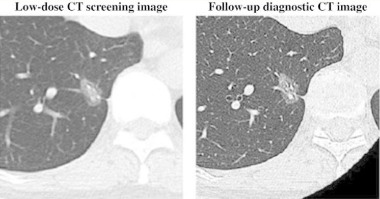 Low-dose ct for lung cancer screening bronchoalveolar carcinoma